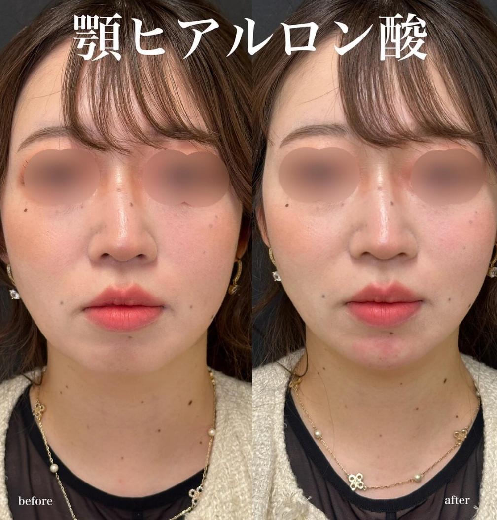 玻尿酸填充