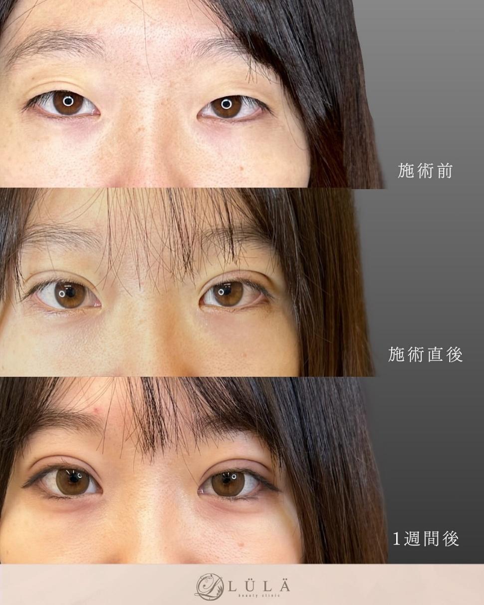 双眼皮手术