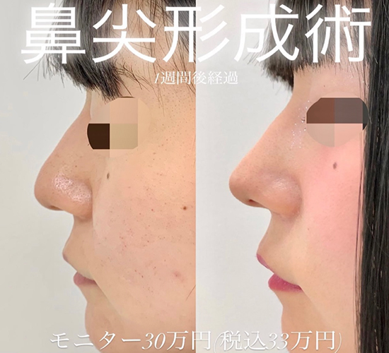 鼻综合整形 + 鼻尖整形 - 切开法