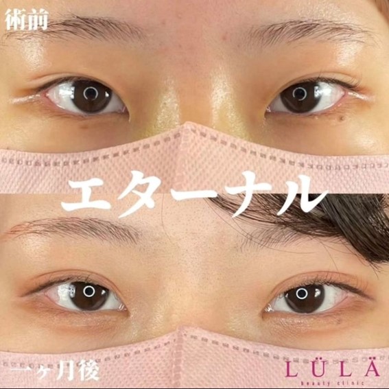 双眼皮手术