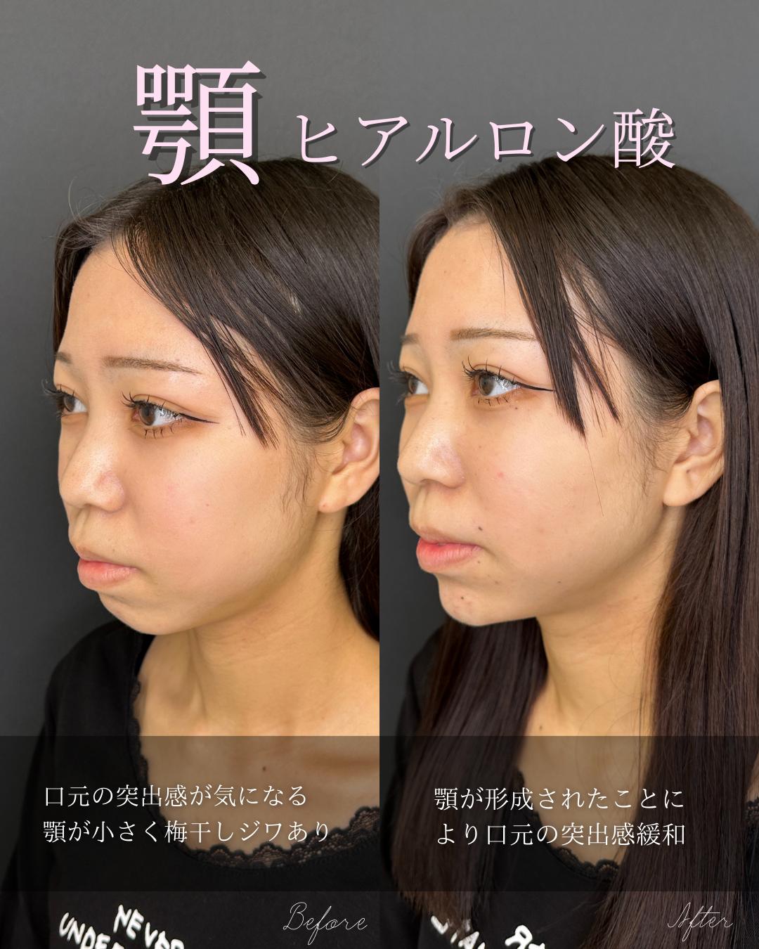 玻尿酸填充