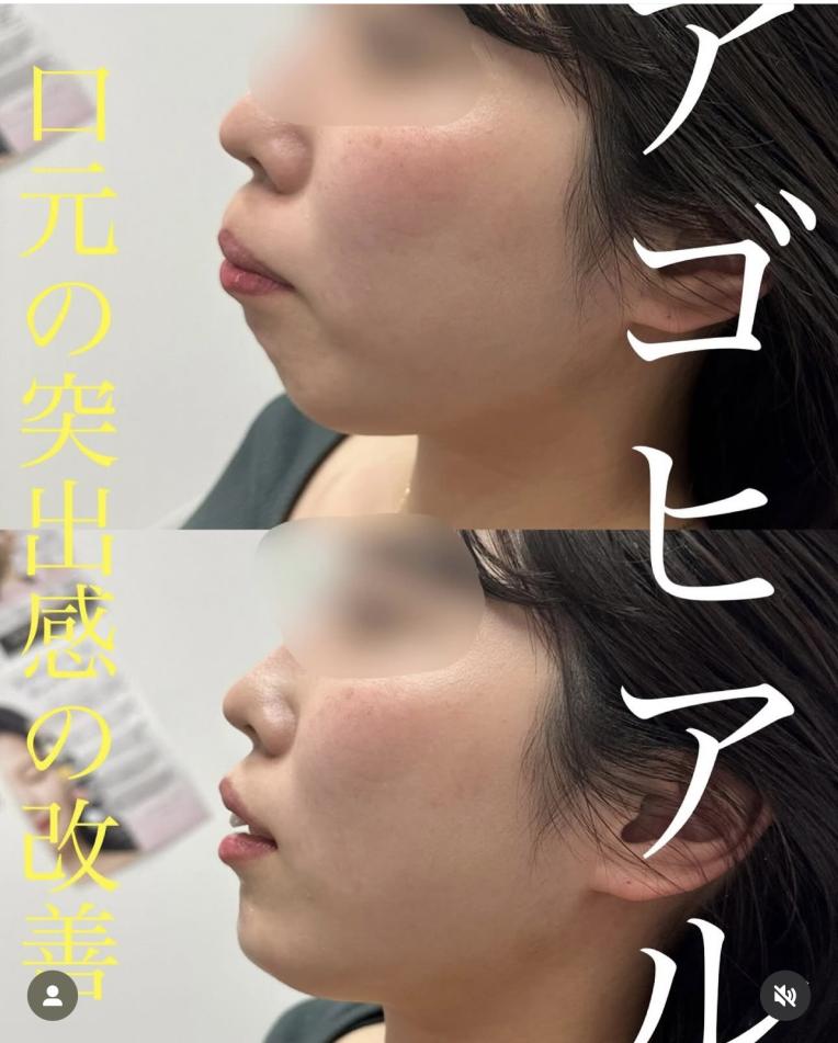 玻尿酸填充
