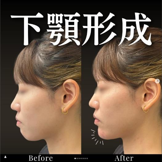 玻尿酸填充