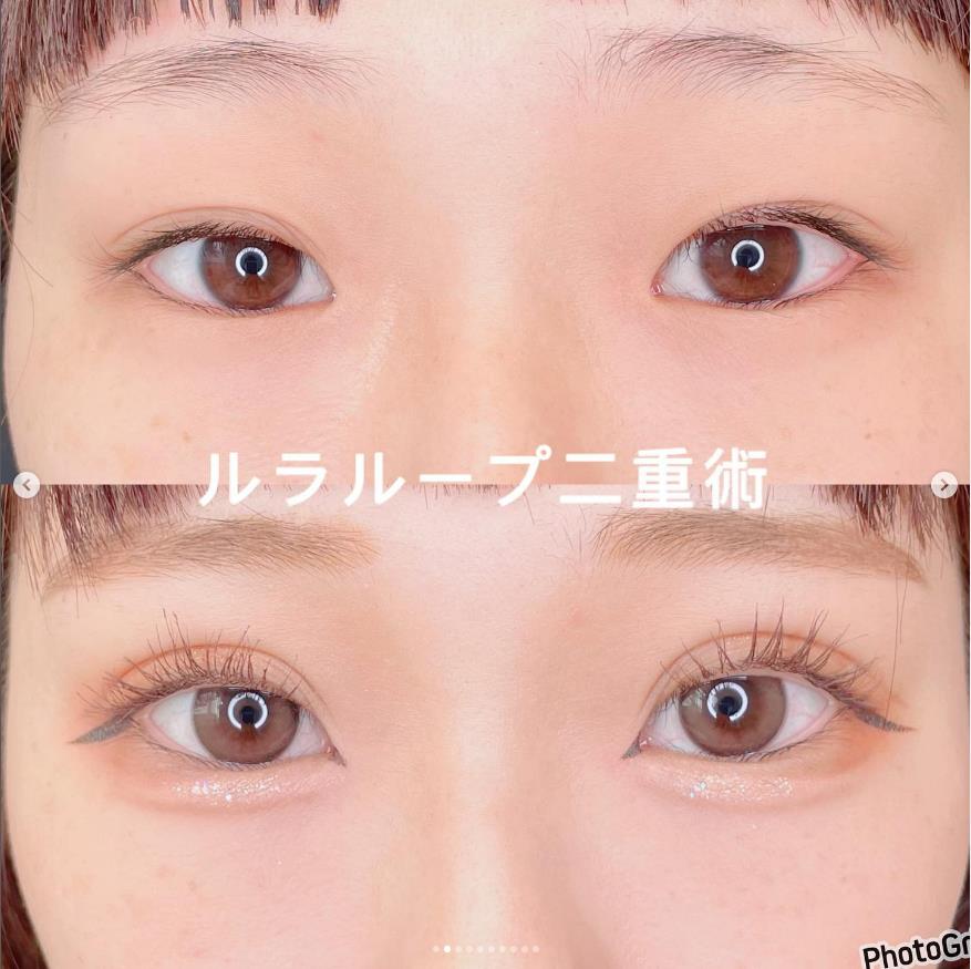 双眼皮手术