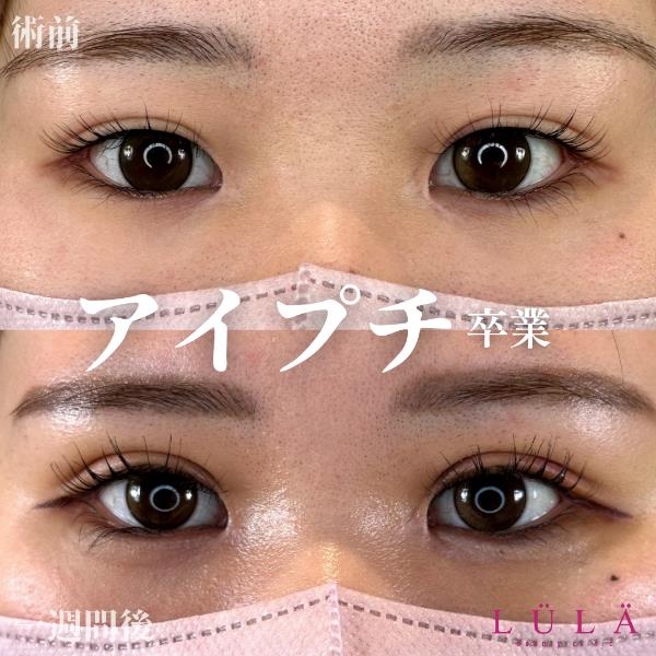 双眼皮手术