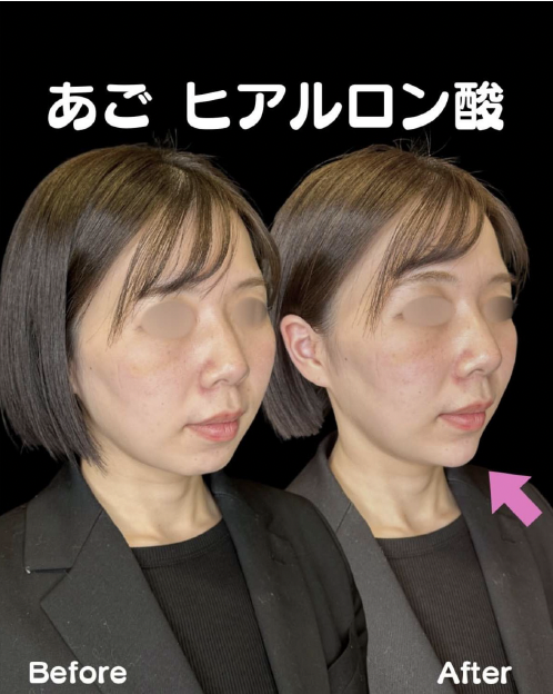 玻尿酸填充