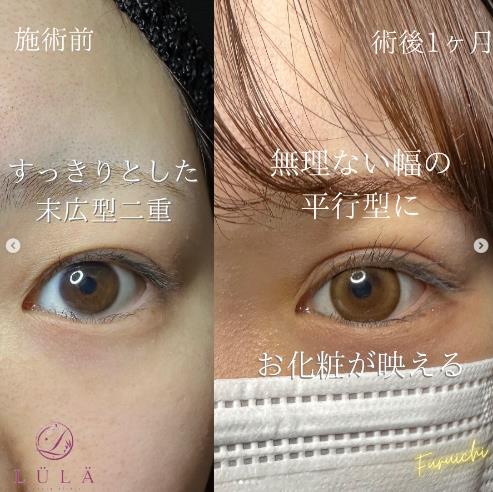 双眼皮手术