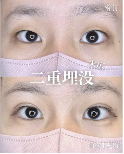 双眼皮手术