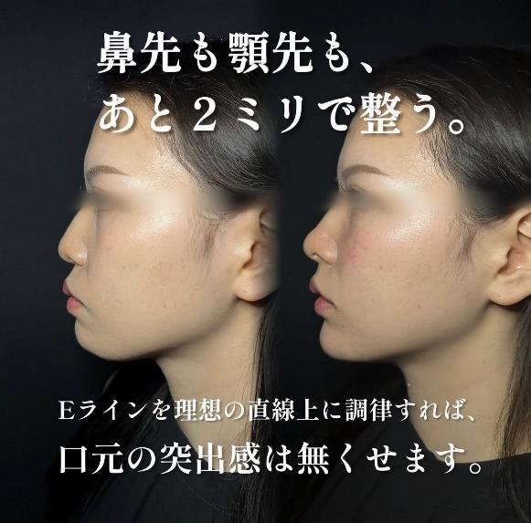 玻尿酸填充