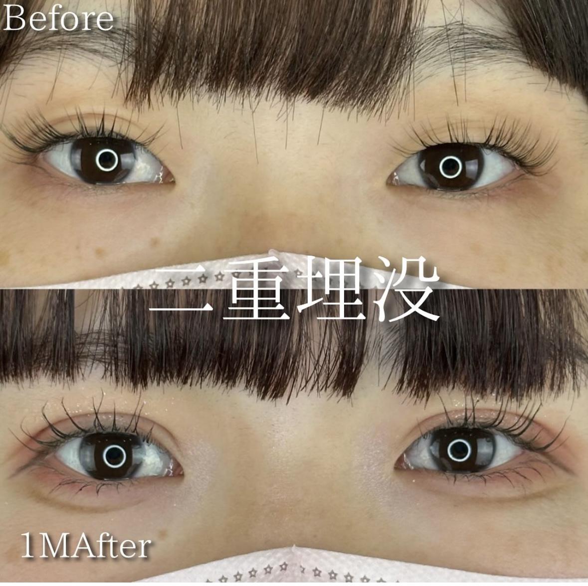 双眼皮手术