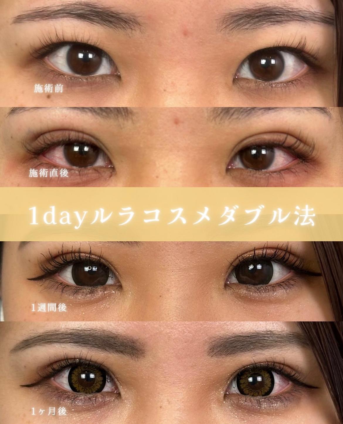 双眼皮手术