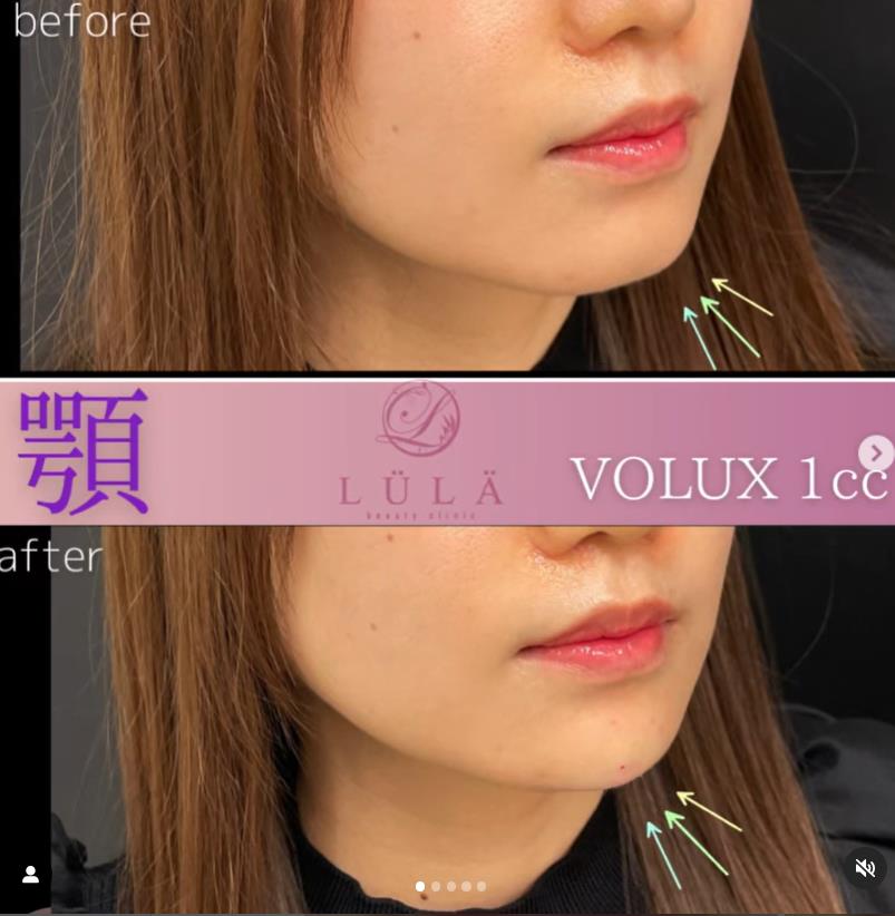 玻尿酸填充