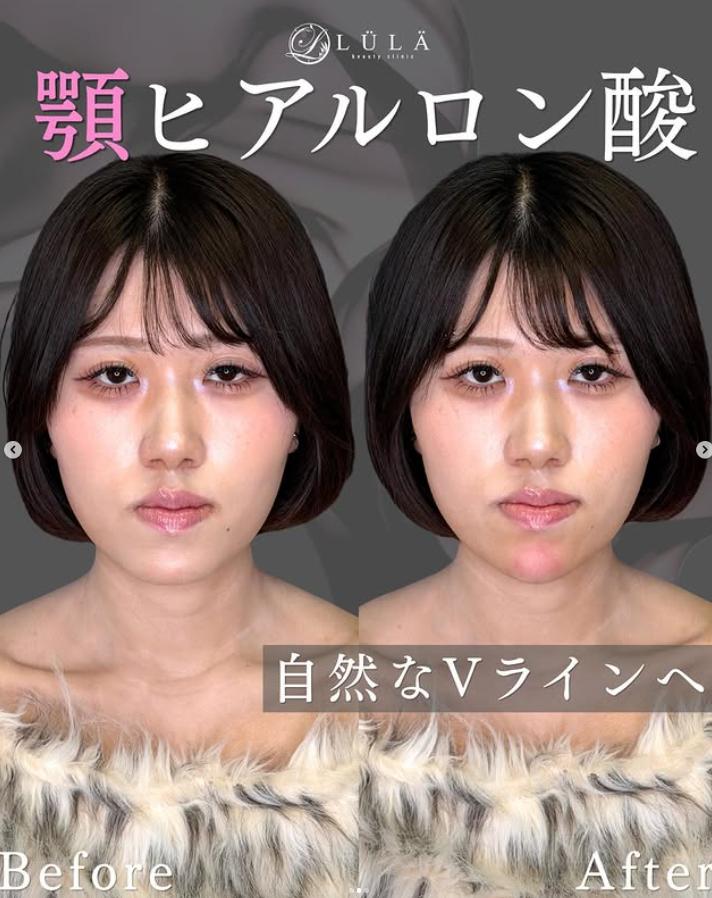 玻尿酸填充