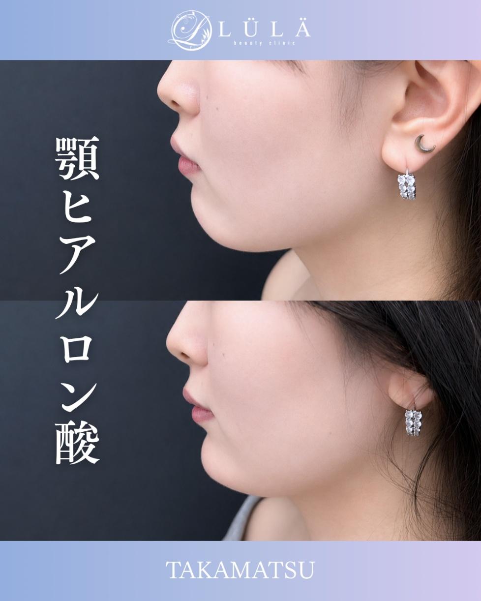 玻尿酸填充