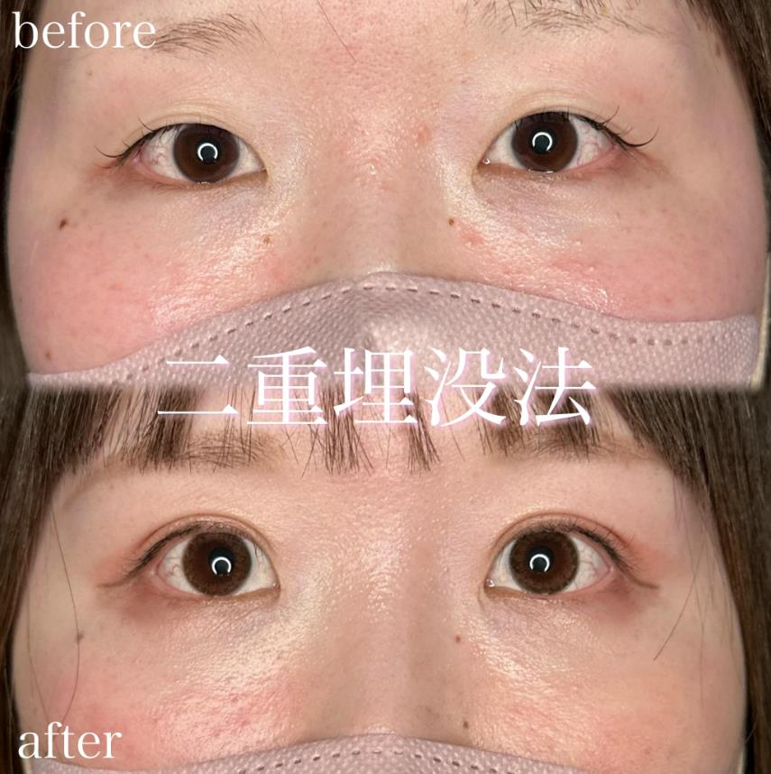 双眼皮手术
