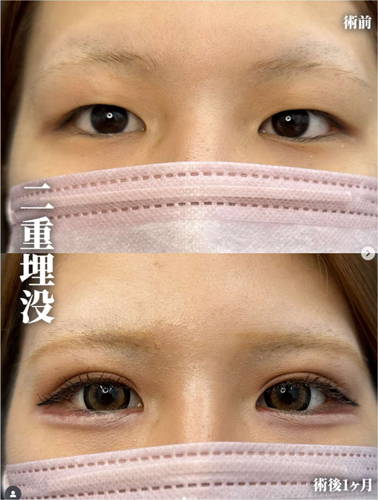 双眼皮手术