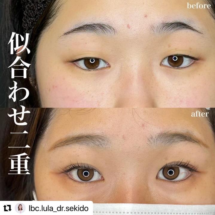 双眼皮手术