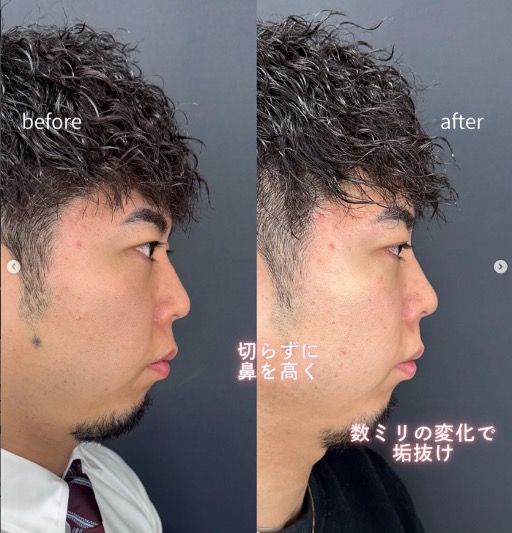 玻尿酸填充