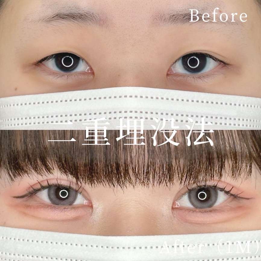 双眼皮手术