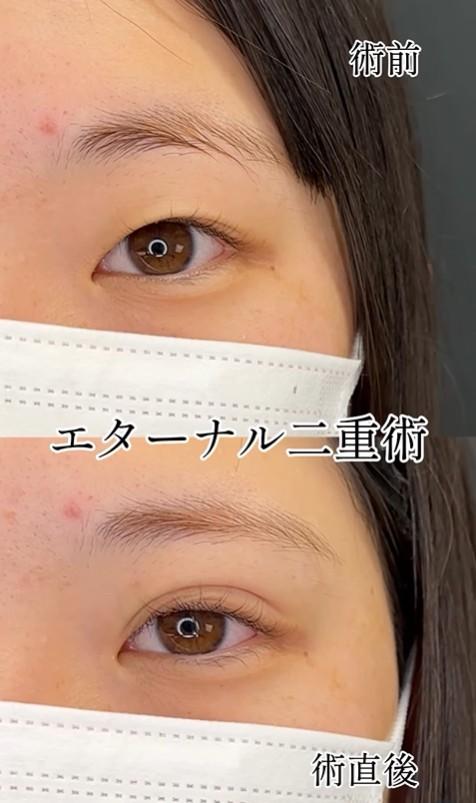 双眼皮手术