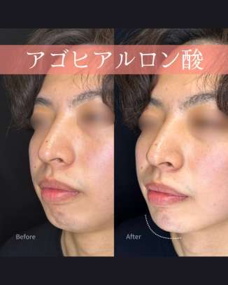 玻尿酸填充