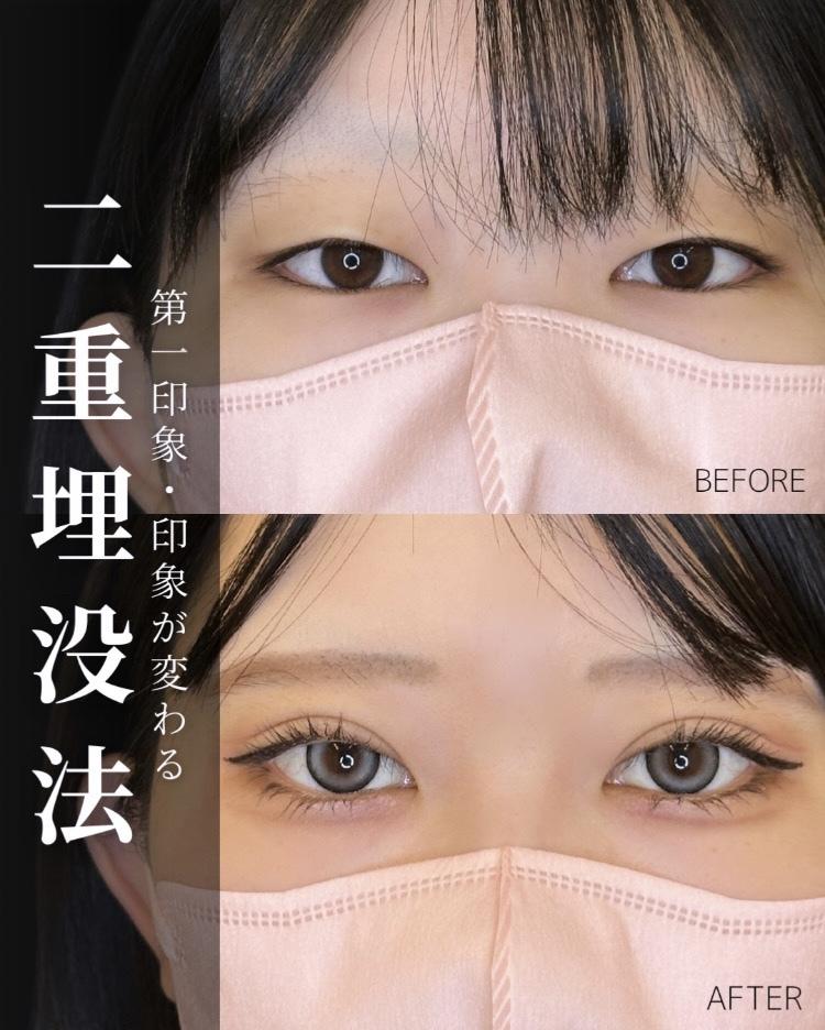 双眼皮手术
