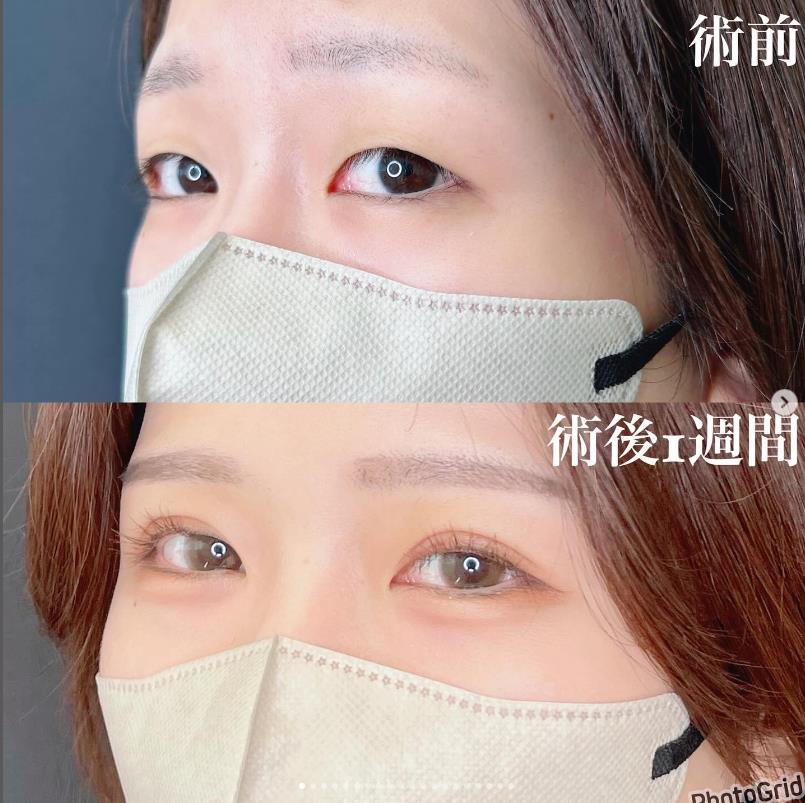 双眼皮手术