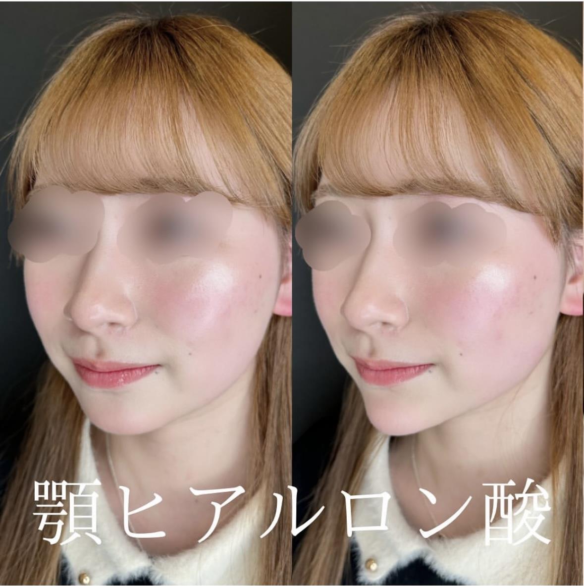 玻尿酸填充