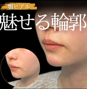 玻尿酸填充