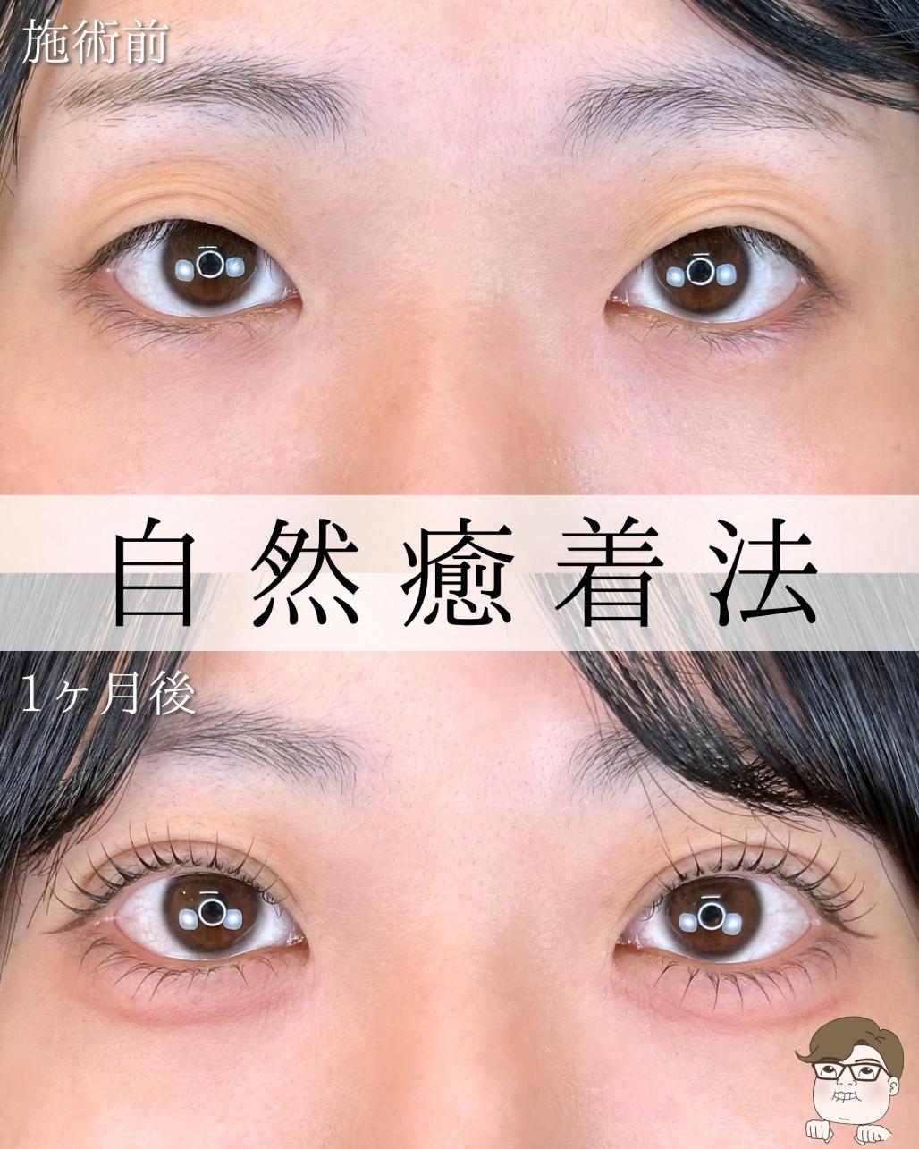 双眼皮手术