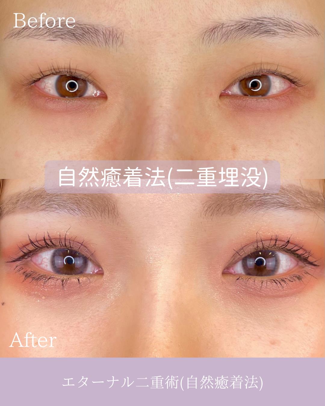 双眼皮手术