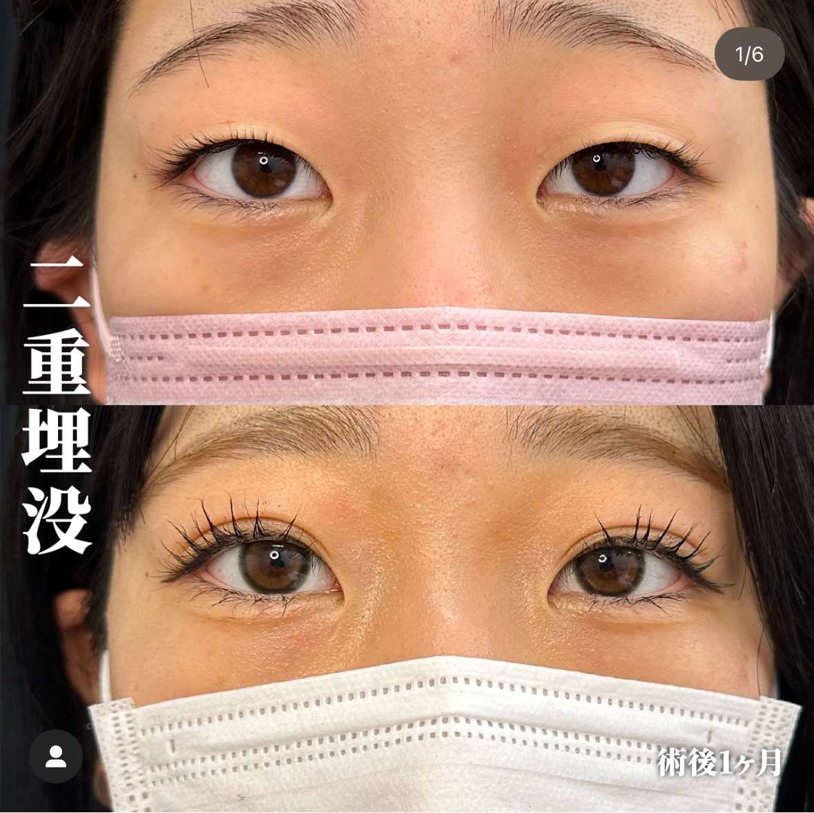双眼皮手术