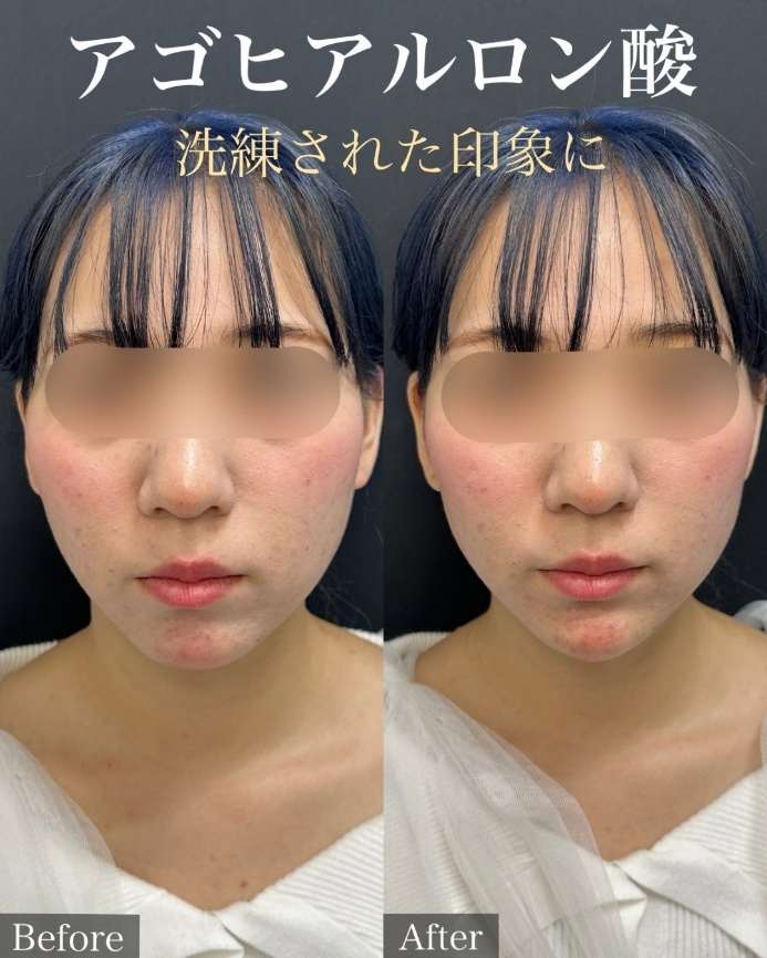 玻尿酸填充