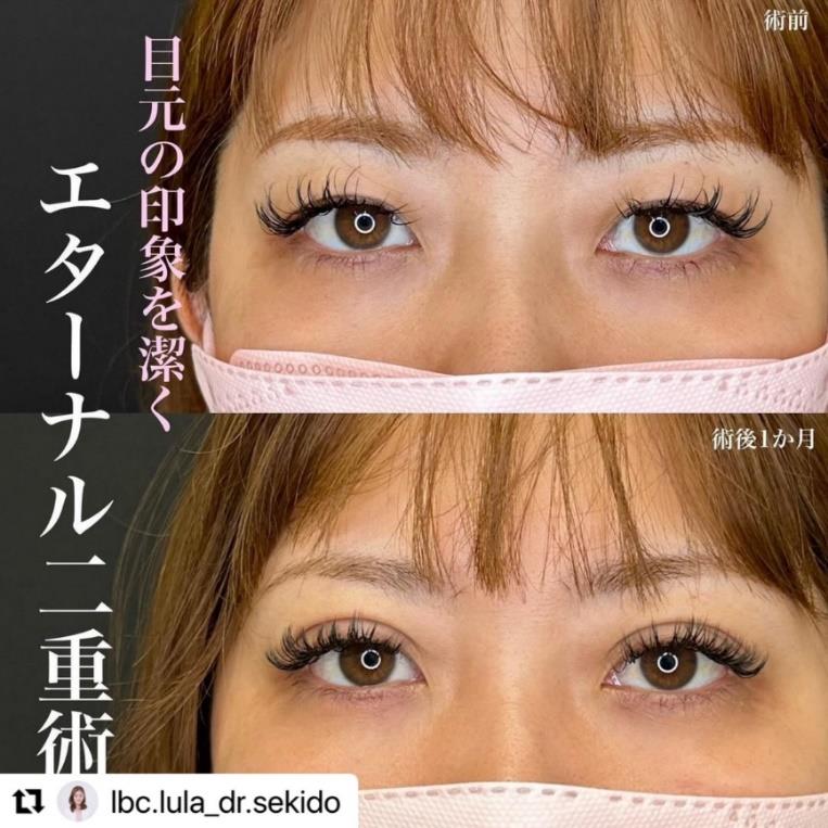 双眼皮手术