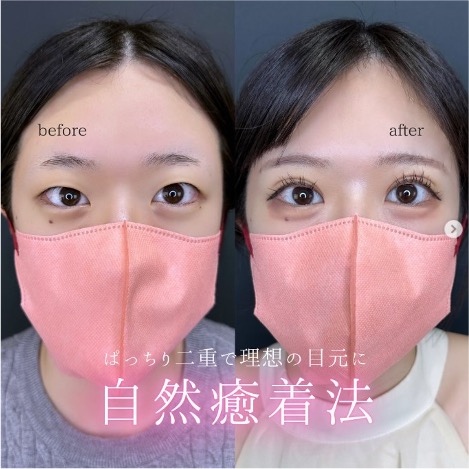 双眼皮手术