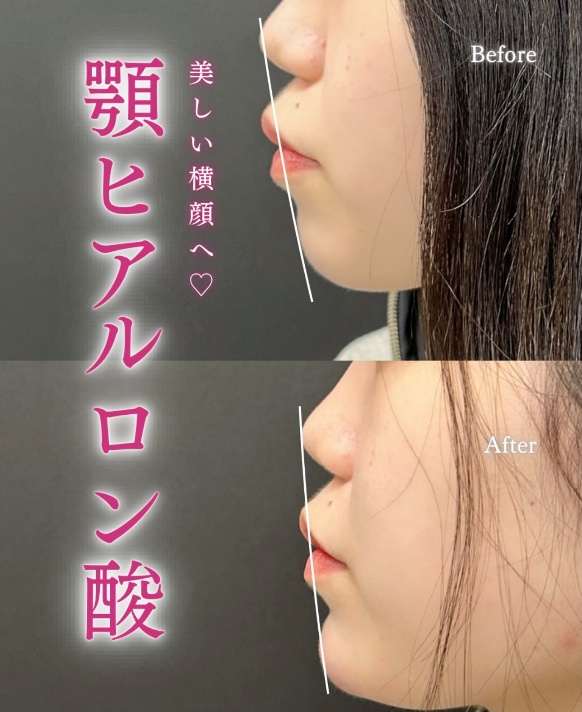 玻尿酸填充