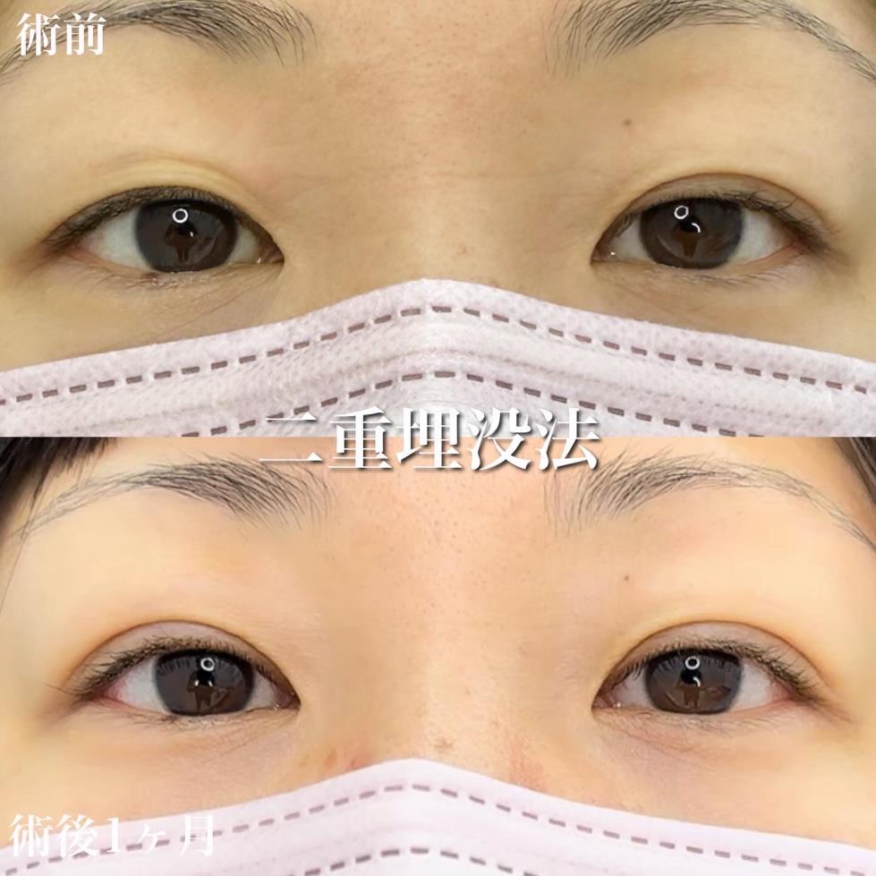 双眼皮手术