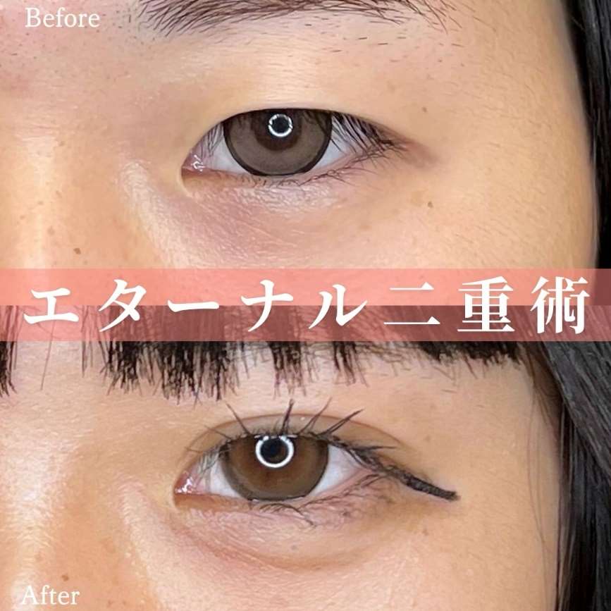 双眼皮手术