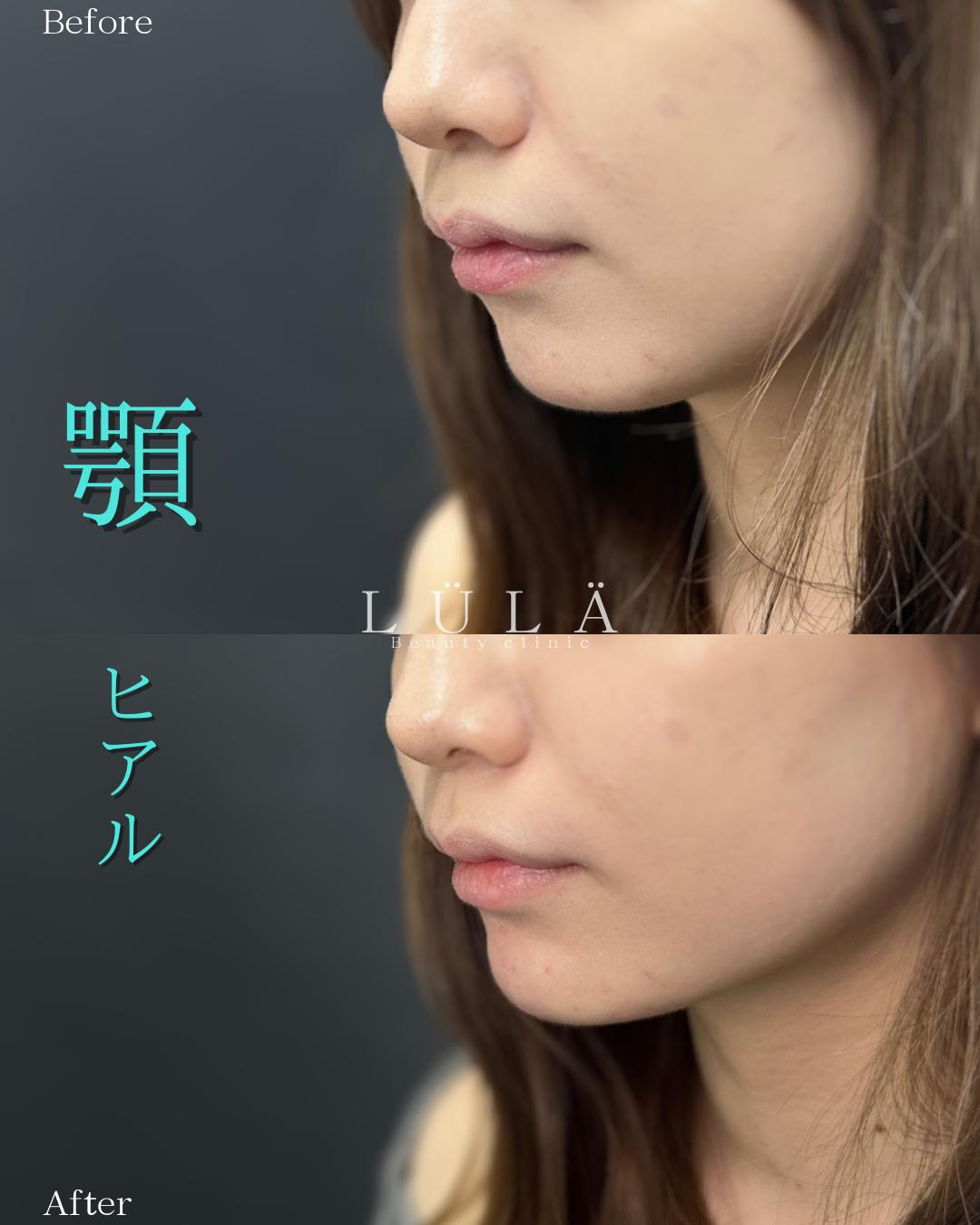玻尿酸填充