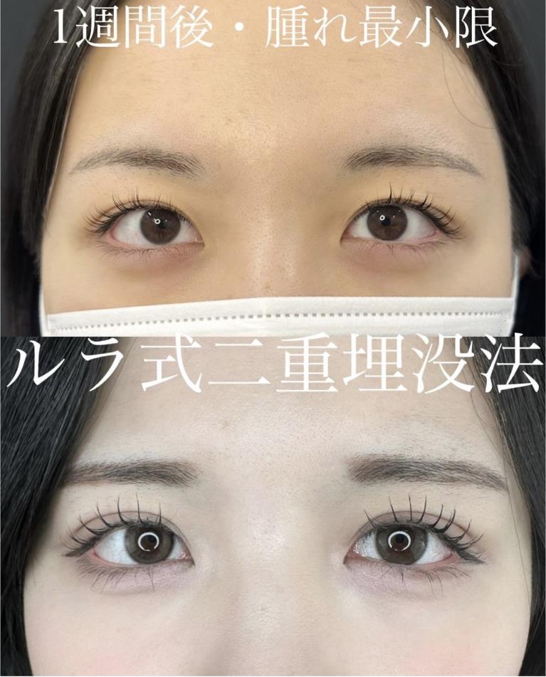 双眼皮手术