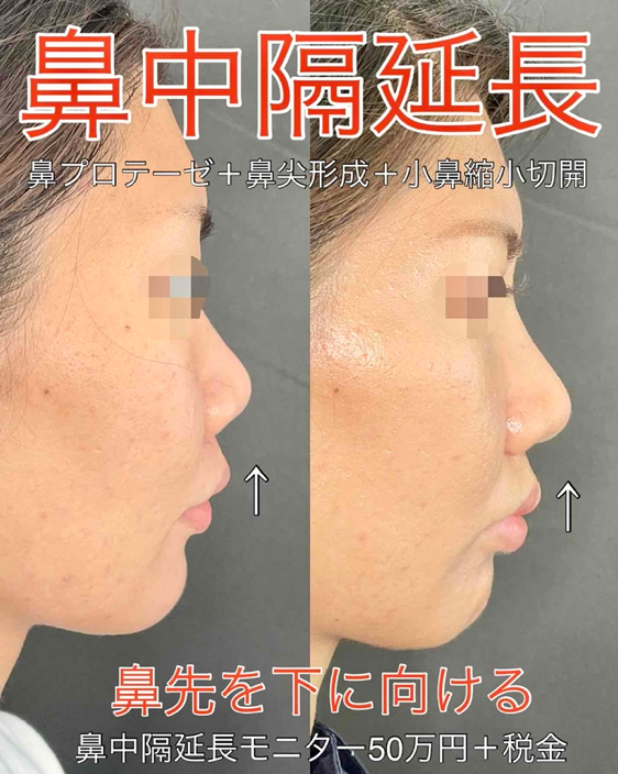 鼻综合整形 + 鼻梁整形 - 硅胶假体 + 鼻尖整形 - 鼻中隔延长术