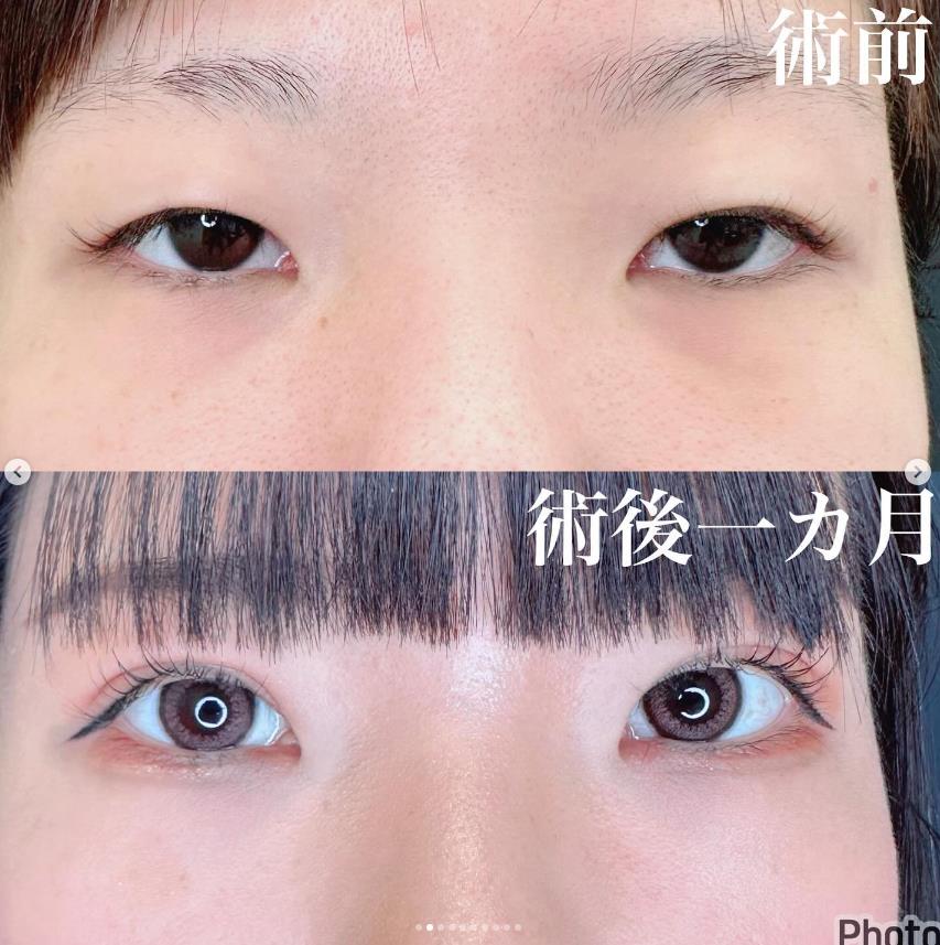 双眼皮手术