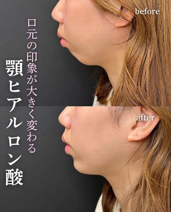玻尿酸填充