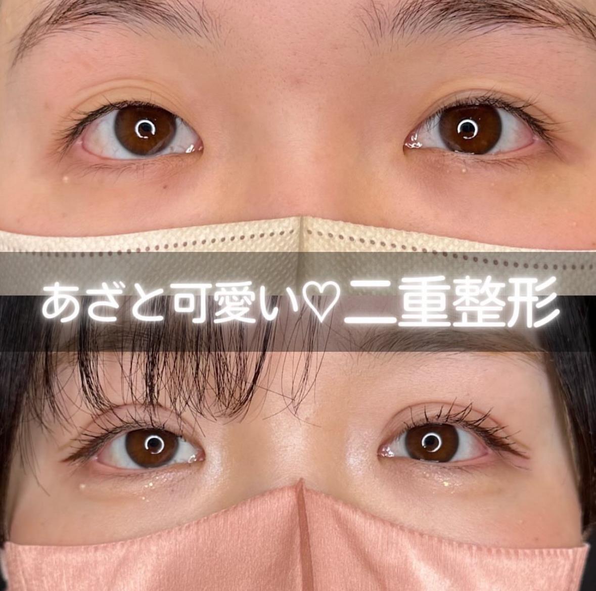 双眼皮手术