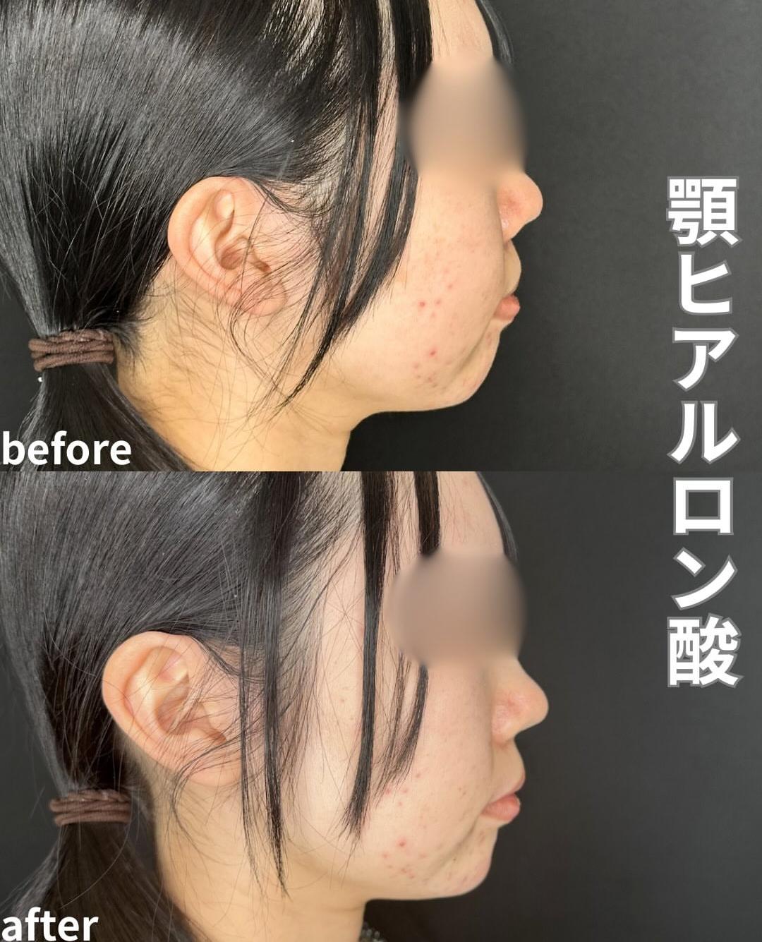 玻尿酸填充