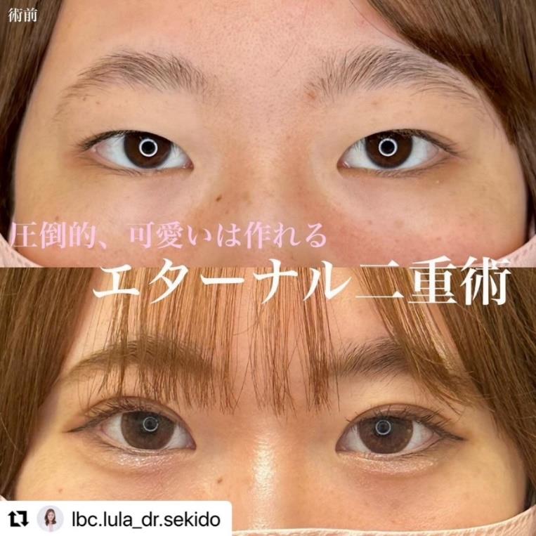 双眼皮手术