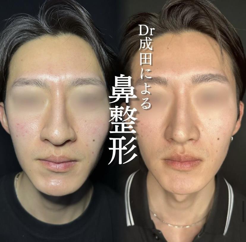 鼻综合整形 + 鼻尖整形 - 切开法