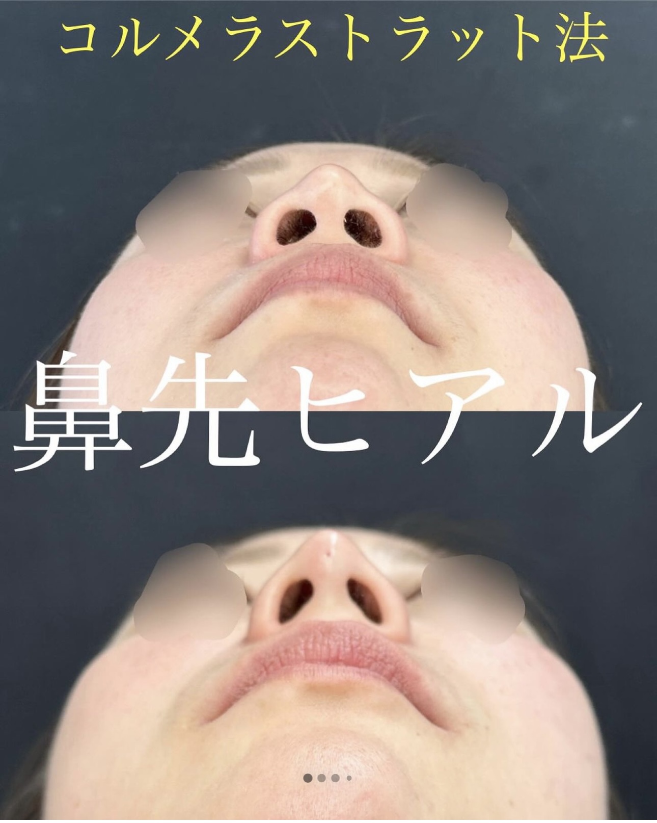 玻尿酸填充