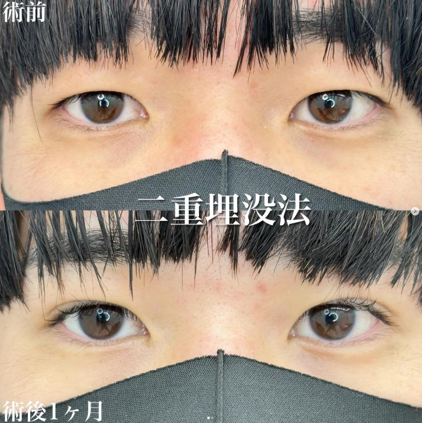 双眼皮手术