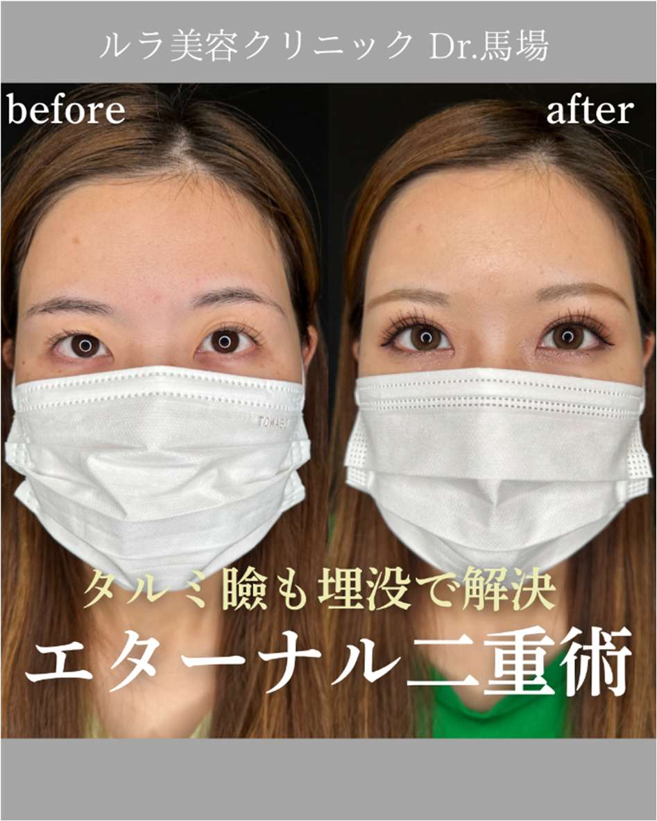 双眼皮手术